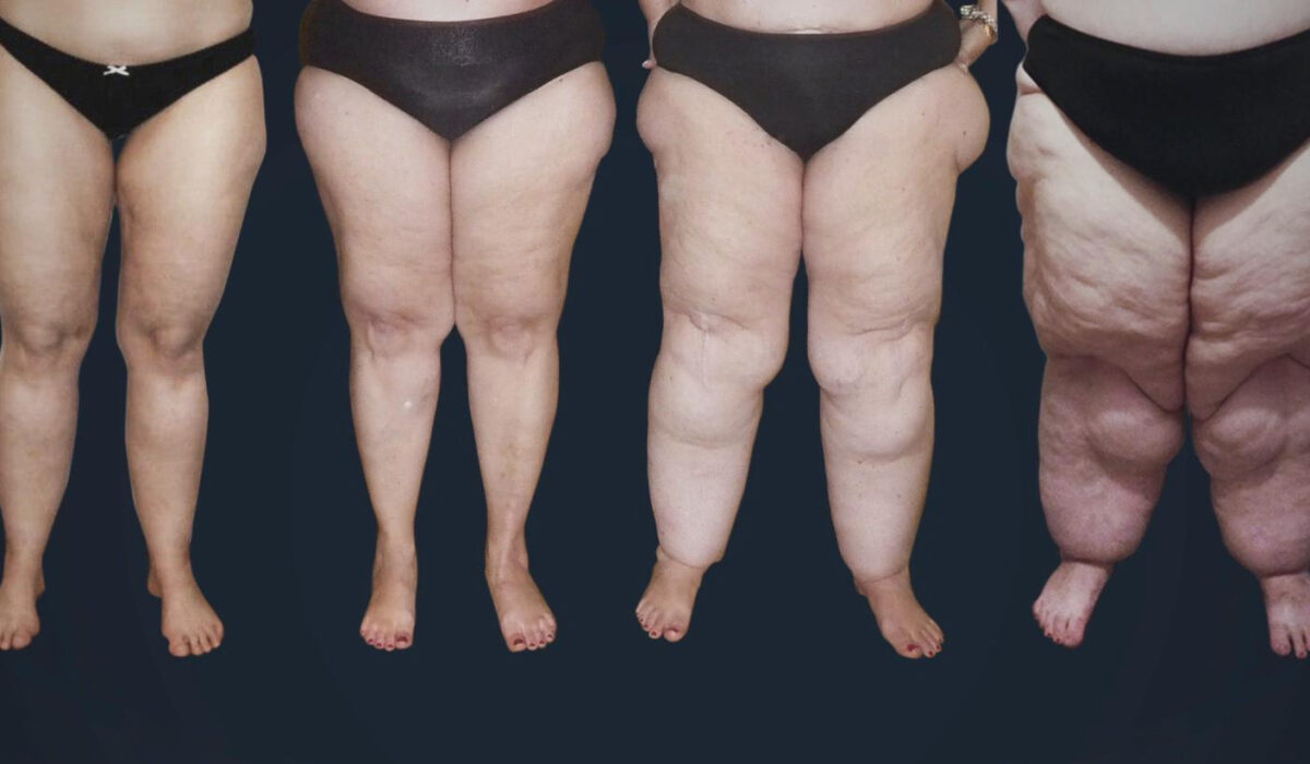 Trattamento del lipedema a Genova. Donne con lipedema