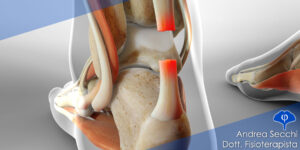 Scopri di più sull'articolo Rottura del tendine di Achille