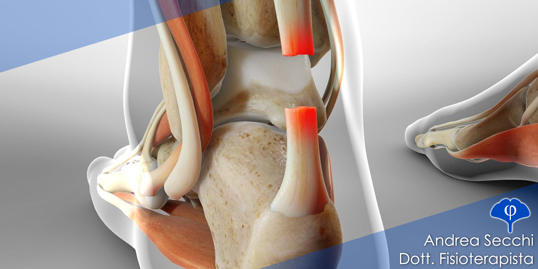 Al momento stai visualizzando Rottura del tendine di Achille